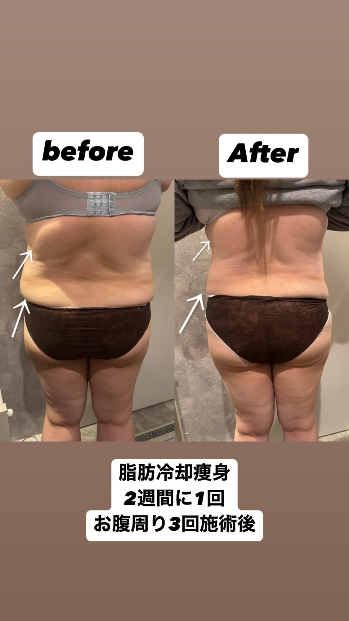 脂肪冷却痩身 2週間に1回・お腹まわり3回施術後の変化